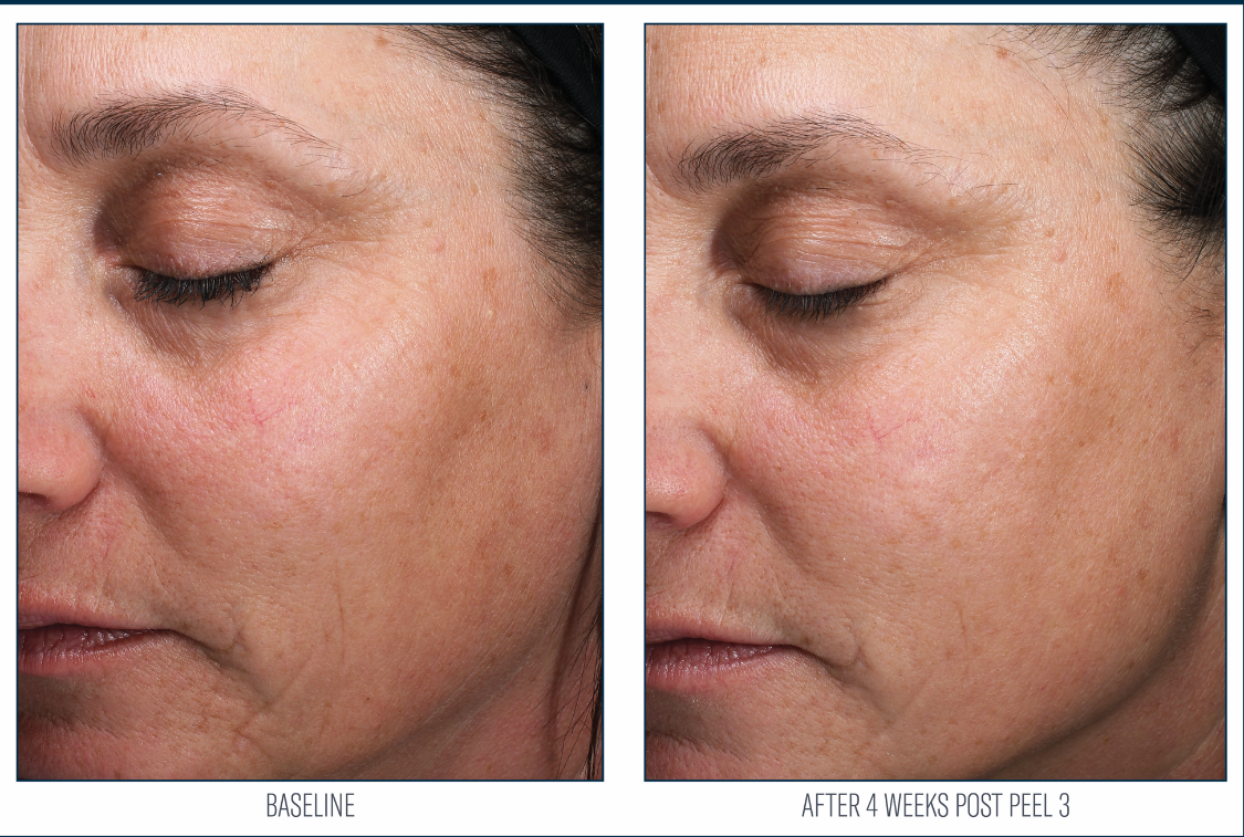 Before and after photos showing results four weeks after the third peel treatment