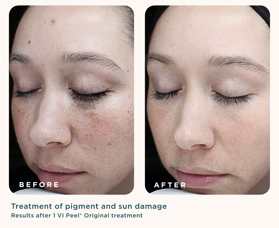 Before and after photos showing treatment of pigment and sun damage after one VI Peel treatment
